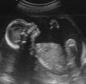 20 week scan photo